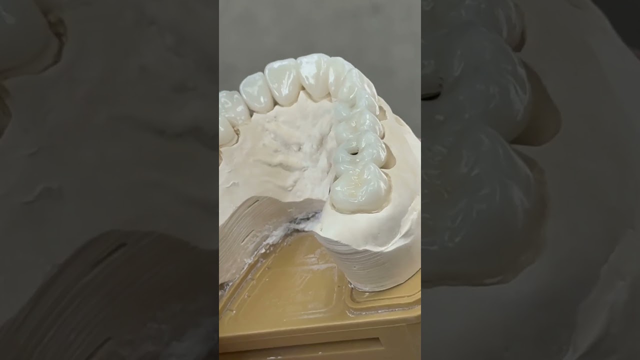 Esthetic full mouth zirconia with implants!