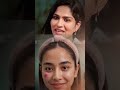 clindamycin and nicotinamide gel for pimples #skincare