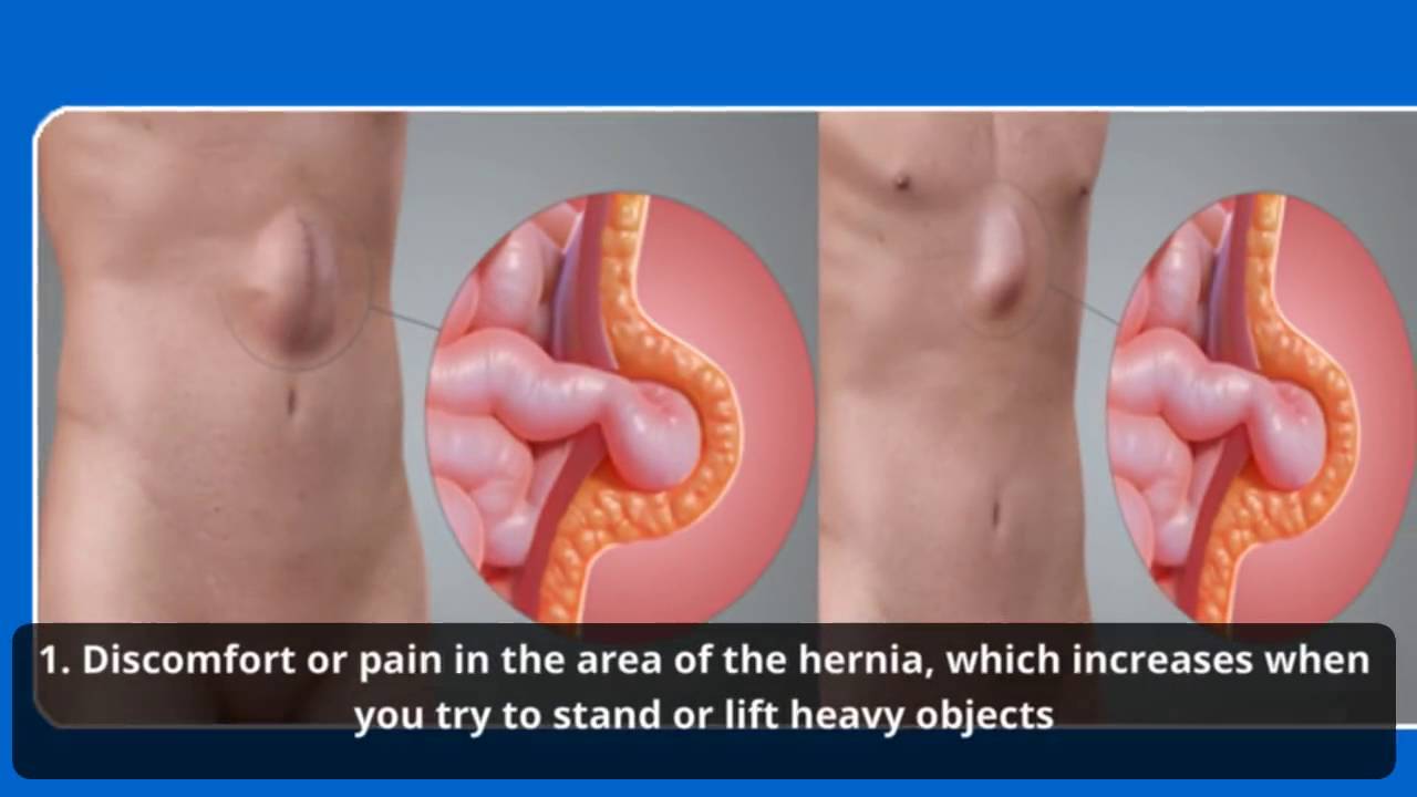 What are the symptoms of a ventral hernia?