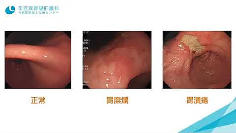 為什麼明明胃在痛，做胃鏡的時候醫生卻說沒問題？｜李宜霖醫師 - 天天要聞