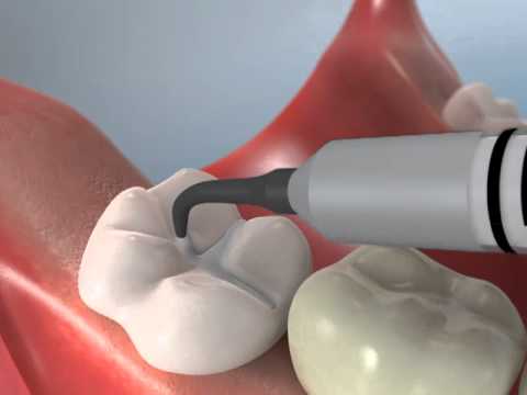 वीडियो: दंत सीलेंट का आविष्कार किसने किया?