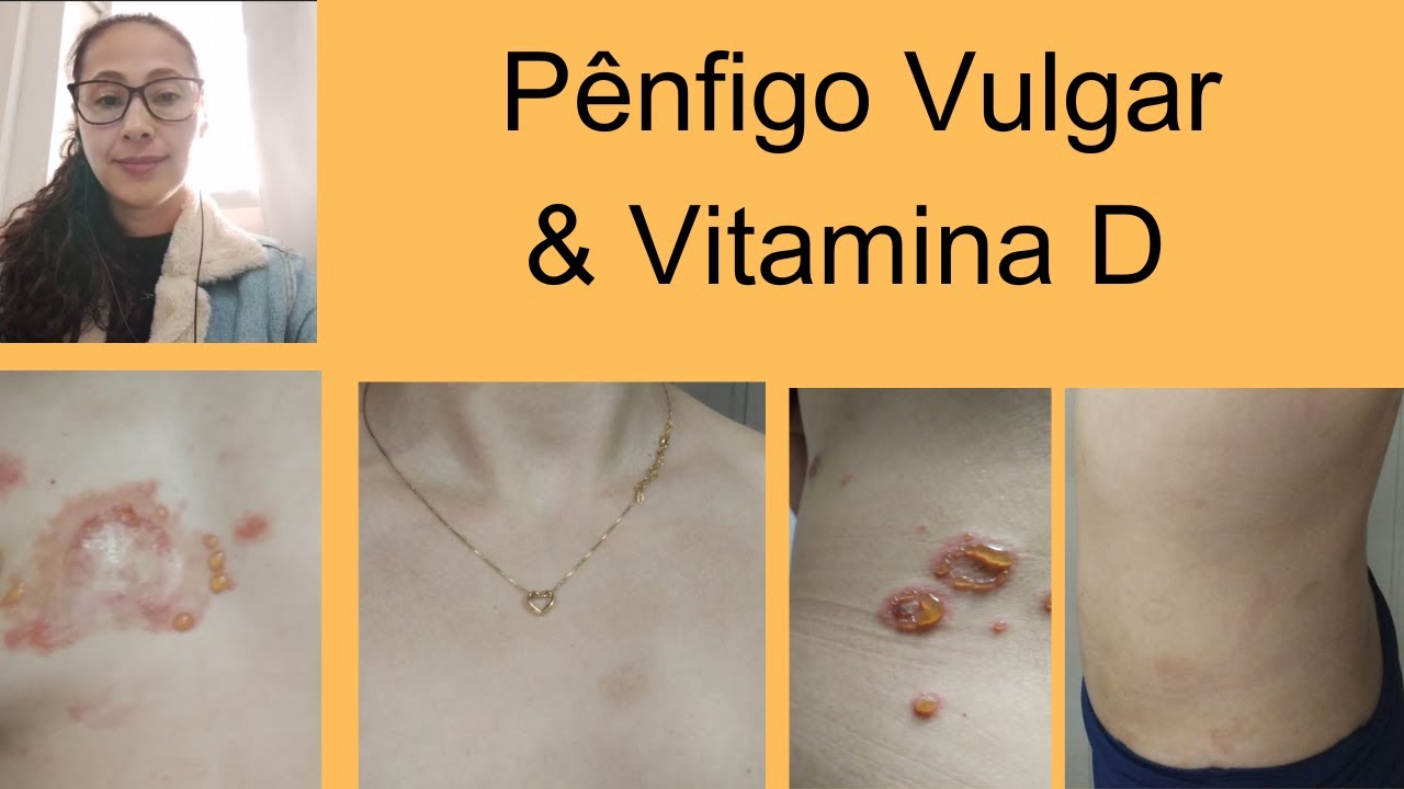 Janaina - Pênfigo Vulgar #1093