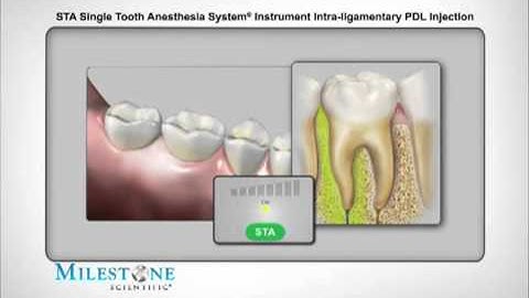Milestone STA Injection Technique PDL Injection