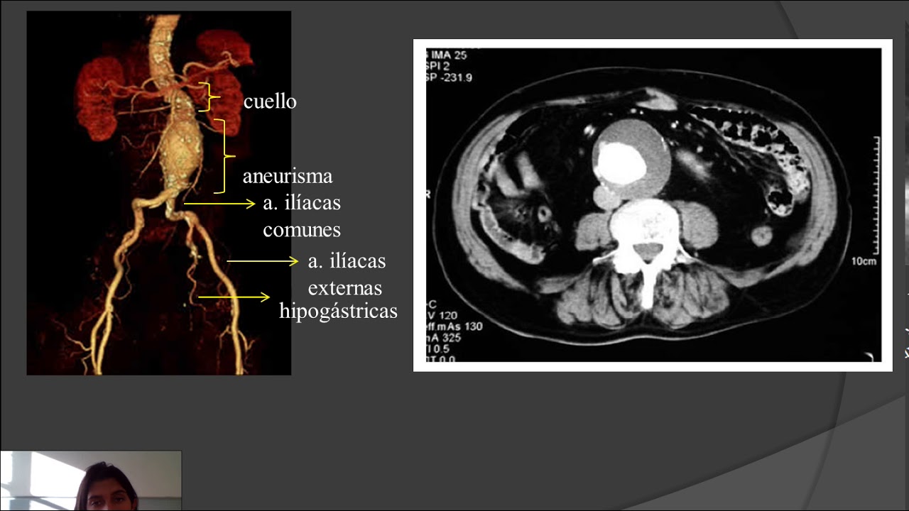 Aneurisma Da Aorta Toracica 3d