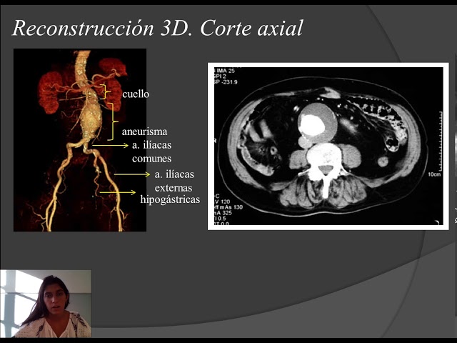 Radiografia De Aneurisma De Aorta Abdominal Aneurisma Micótico De La
