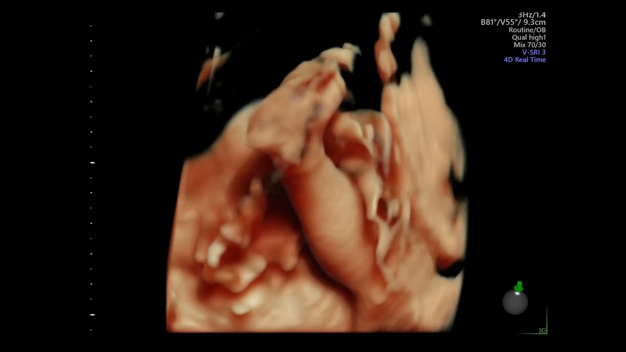 Ecografia Obstétrica 3D/4D