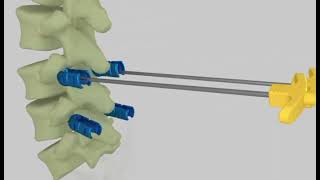 Cement Augmented Pedicle Screw System