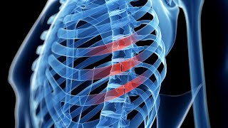 broken ribs will now be connected faster with this new surgery