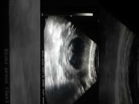 شكل الجنين في الشهر الثاني من الحمل