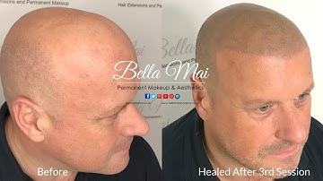 3. Scalp Micropigmentation - Before & After 1st, 2nd & 3rd Session Healed