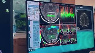 MRI brain spectroscopy in multi voxel on GE 1.5T with full detailed post processing