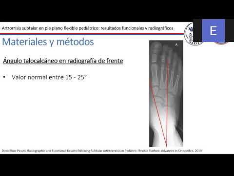 Vídeo: Què és una fusió articular subtalar?