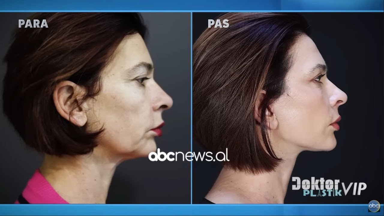 Ema Andrea ben transformimin e madh ne Doktor Plastik | ABC News Albania