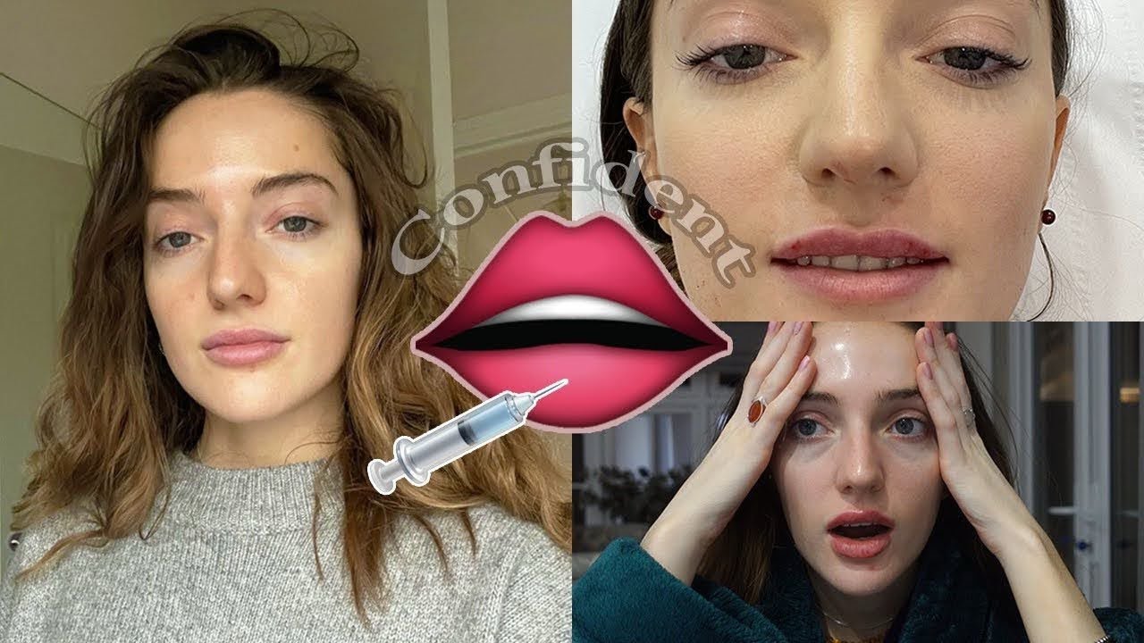 first time lip filler 1ml Therapie Clinic BLUEWATER