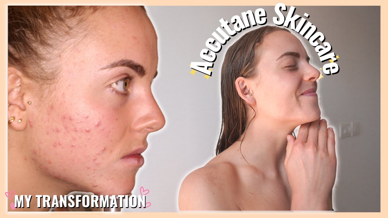 Skincare on Accutane | Isotretinoin transformation
