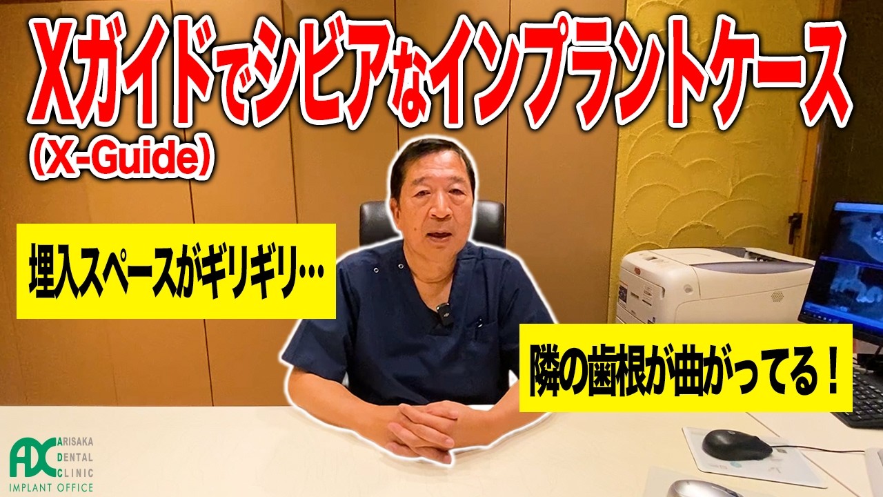 隣の歯根が曲がってる！埋入スペースがギリギリ…Xガイド（X-Guide）でシビアなインプラントケース 有坂歯科