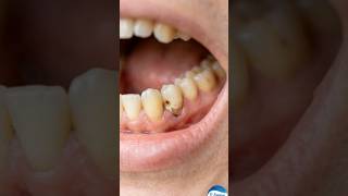 Gum Line Tooth Repair : A Cinematic Step-by-Step Restoration #toothrepair #restoration