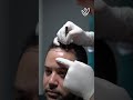 Hair transplant procedure  estenove