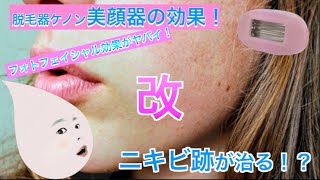 脱毛器ケノンの美顔器を１年半使ってみた！美白効果とニキビ跡が治るか検証！『画質・改』