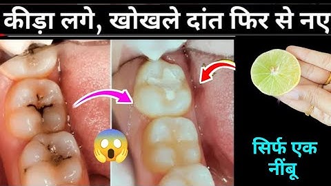 Get rid of tooth cavity, cold, hot, yellowness, bad breath with this one magical thing Teeth Whit...