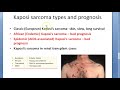 Medicine 337 Kaposi Sarcoma AngioSarcoma Herpes HIV AIDS patient cancer Skin GI doxorubicin