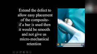 Problem - Void in your newly placed composite. Solution - Dr. Joel N. Janis