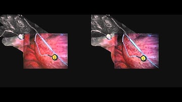 Dense Surface Reconstruction for Enhanced  Navigation in Minimally Invasive Surgery