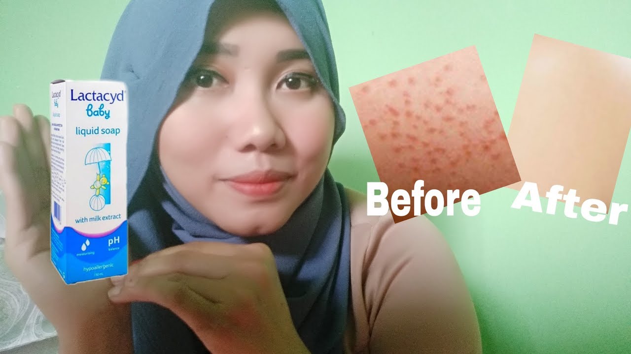 Cara menghilangkan biang keringat pada Bayi (Pengumuman Giveaway)🎆🎆🎇🎆🎇