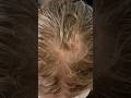 FIX THINNING CROWN?! #hairloss #thinninghair