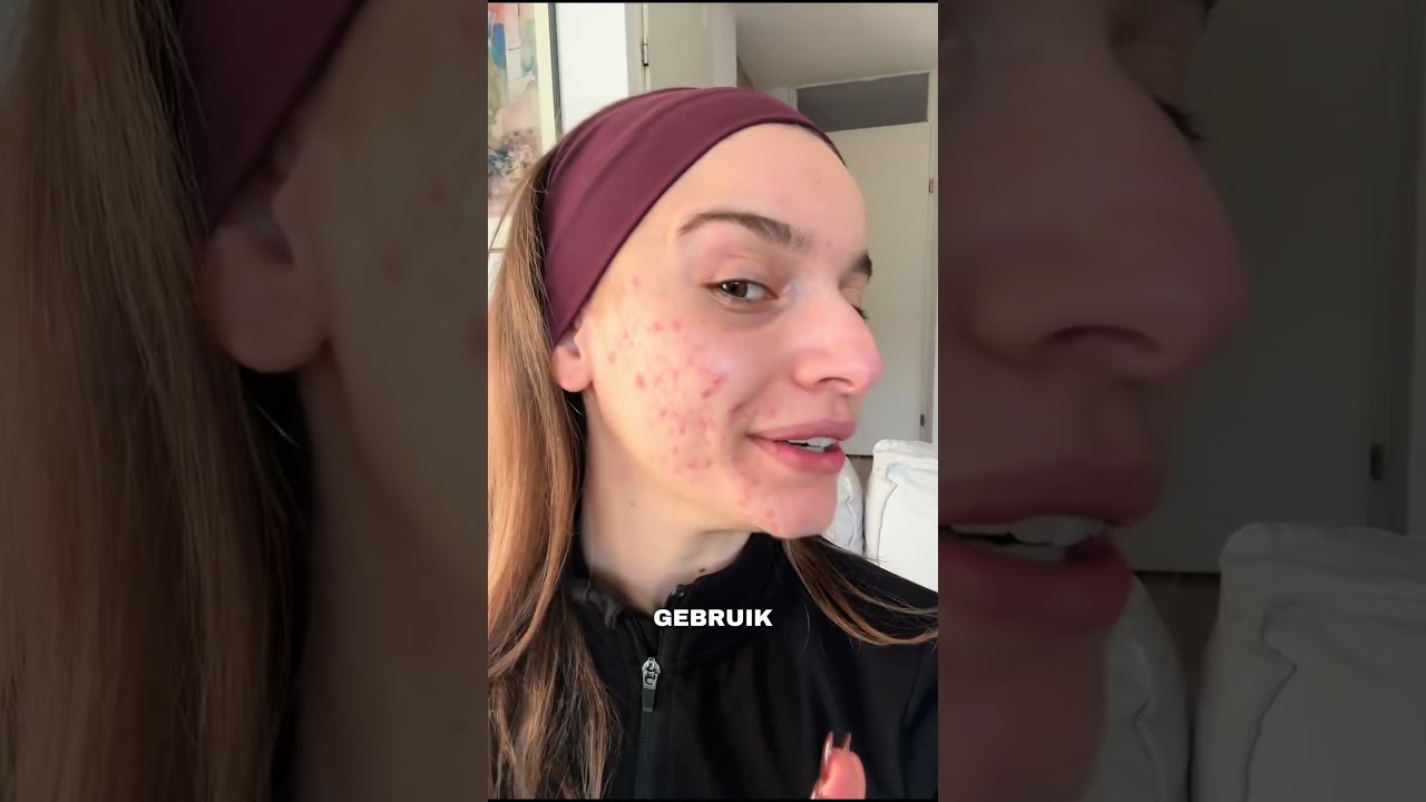 Ik hoop dat je weet dat je niet de enige bent en dat je prachtig bent ook met acne❤️ #mentalhealth