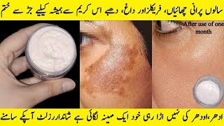 Chaiyan Khatam Karne Ka Tarika - Melasma Aur Pigmentation Ka Ilaj - GET RID OF PIGMENTATION