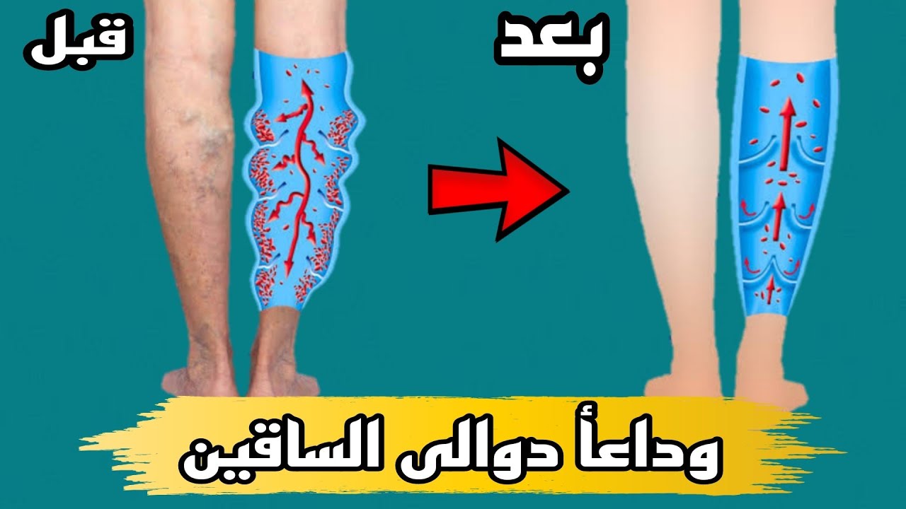 ٣تمارين فقط لعلاج دوالى الساقين جربها ولن تندم |دوالى الساقين الاسباب والاعراض والعلاج النهائي