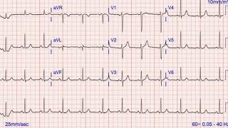 Pemasangan EKG Exstermitas,Anterior, Dexstra, Dan Posterior 