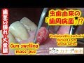 上尾　歯医者　歯周病　「虫歯由来の歯周病⁉」大量膿発生　Periodontal disease derived from caries　เหงือกบวม