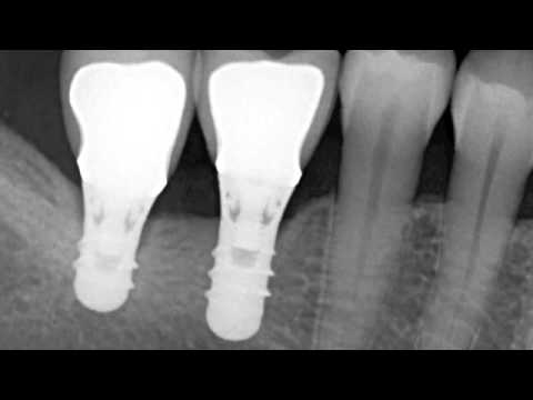 1 minute 1 cas clinique - Episode 4 - Implantologie - YouTube