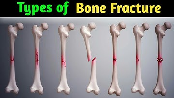 Common types of Bone fracture || 3D animation