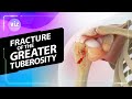 Fracture of the Greater Tuberosity (3D Animation)