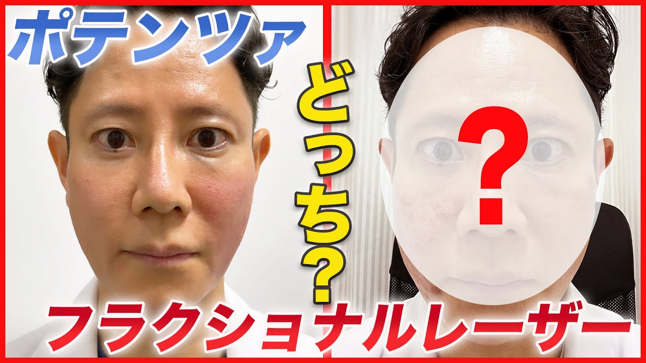 【ニキビ跡/毛穴】ポテンツァとフラクショナルレーザーのどちらを選ぶべき？