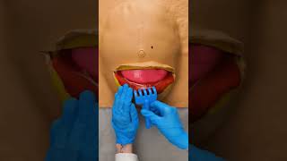 Cesárea El Parto Por Cesárea. Simulación En Maqueta De Plastilina