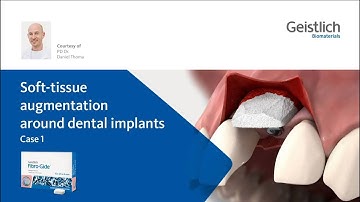 PD Dr. Daniel Thoma: Soft-Tissue augmentation around dental implants