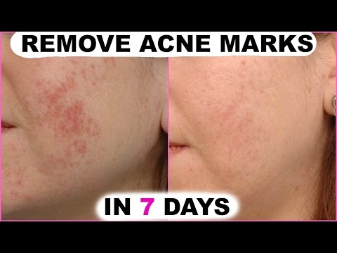 Pimples के निशान हटाये | Remove Acne Marks in  days