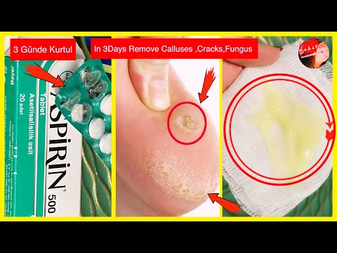 Add This To Aspirin And Just in 3 Days, Remove Calluses, Cracks and Fungus of the Feet