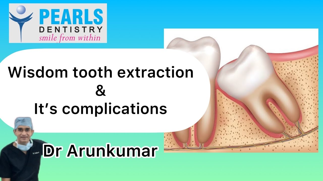 wisdom tooth / 3rd molar extraction and it's complications | Dr Arunkumar | Pearls Dentistry