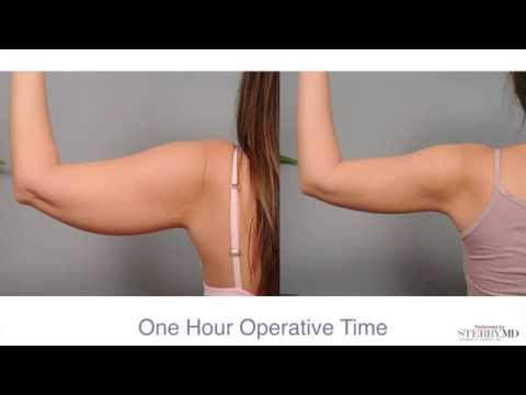 Get firm, sculpted arms with Smartlipo&trade;