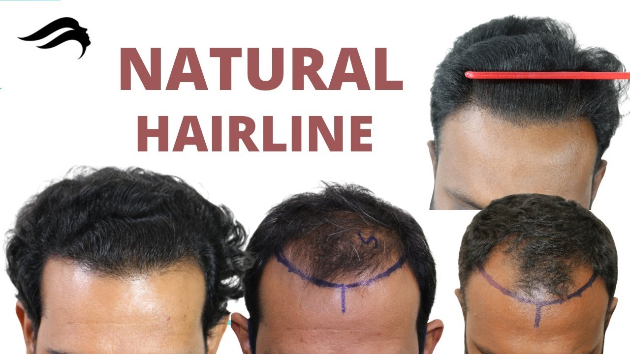 Hair Transplant In Bangalore | Best Cost And Results Of Hair Transplant In  Bangalore - YouTube