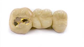 FAQ - What is the difference between a crown and a cap? | Paige Prather Smiles