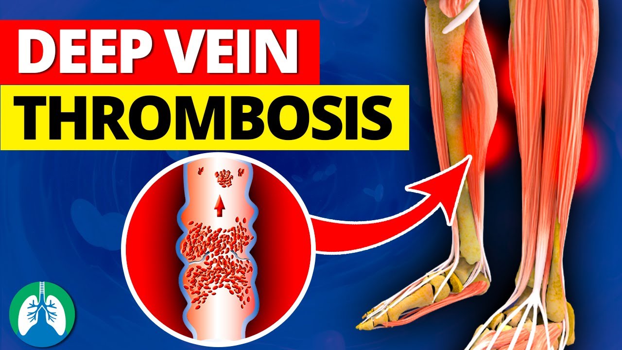 Deep Vein Thrombosis (DVT)  Quick Medical Overview 