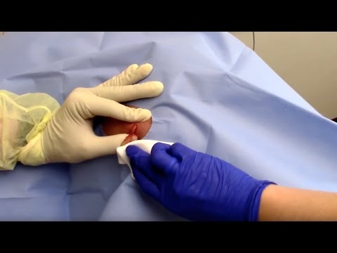 Abscess Drainage Performed by Dermatologist Dr. David Myers