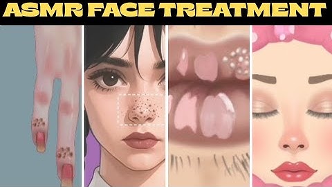 Giant Blackhead Extraction: ASMR - Satisfying Skin Care