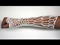 3D-printed Cortex Exoskeleton may be the future of orthopedic casts